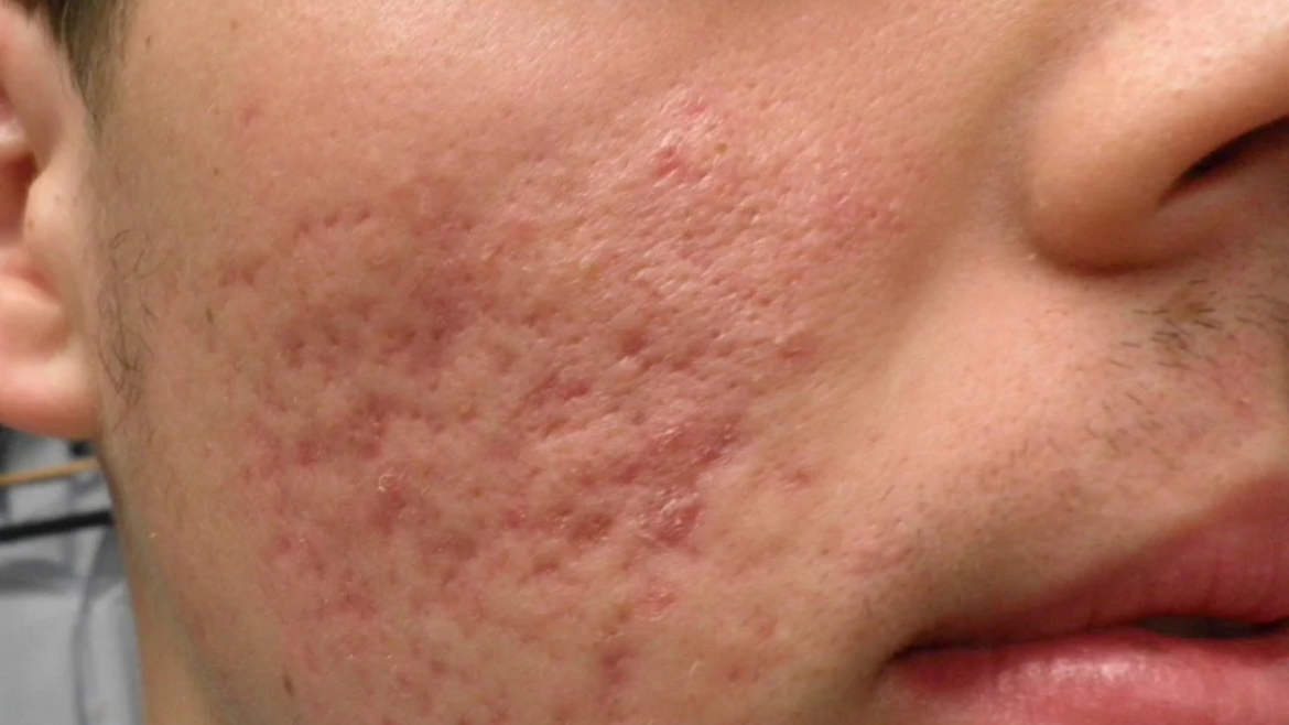 Acne Scars