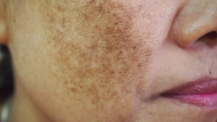 Melasma